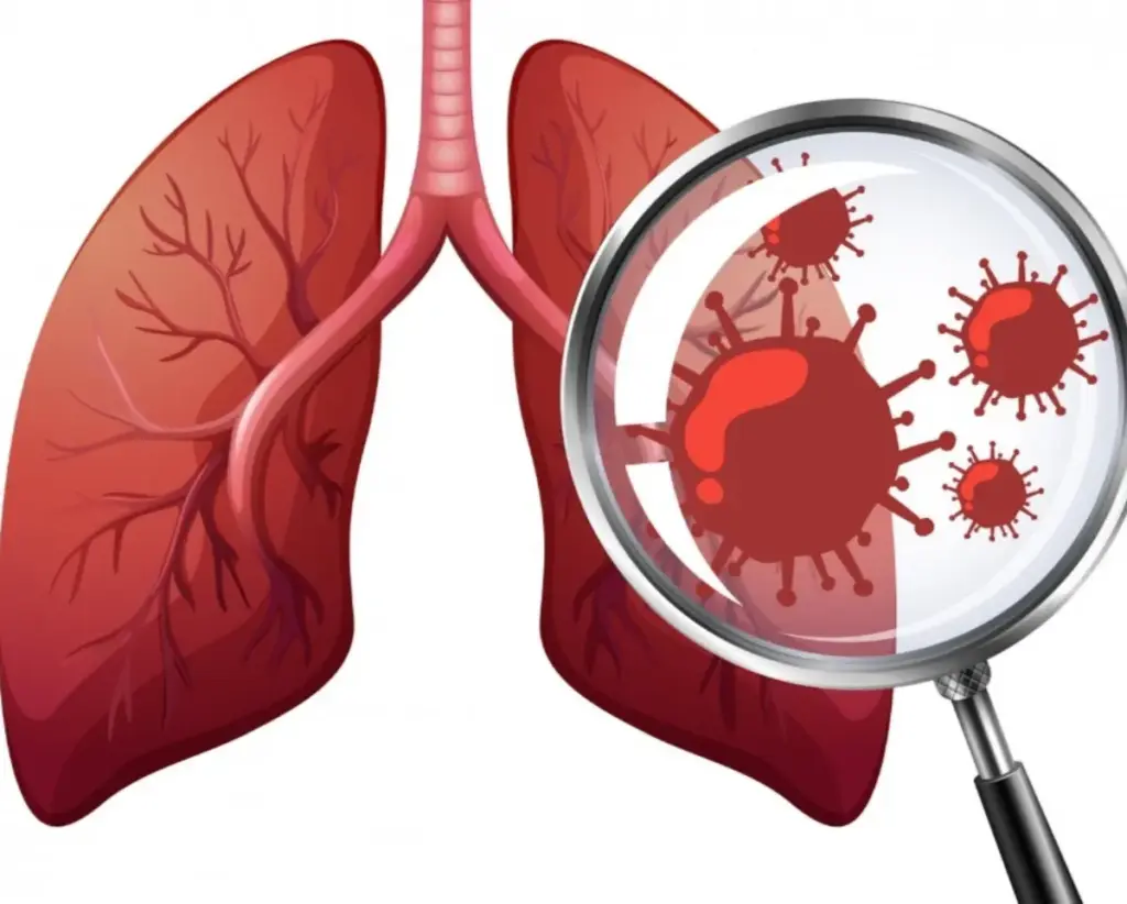Tahun 2025 TBC di Garut Capai 9 ribu Kasus, Dinkes Upayakan Penurunan Tahun 2025 TBC di Garut Capai 9 ribu Kasus, Dinkes Upayakan Penurunan. (Ilustrasi TBC: Freepik/radargarut.id)