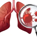 Tahun 2025 TBC di Garut Capai 9 ribu Kasus, Dinkes Upayakan Penurunan. (Ilustrasi TBC: Freepik/radargarut.id)