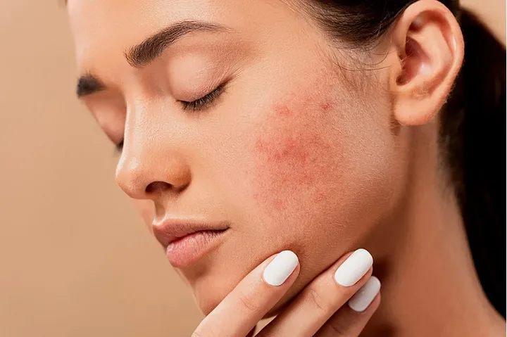 Wajah Sering Breakout Saat Menstruasi? Coba 4 Cara Perawatan Kulit Ini Agar Tetap Sehat dan Glowing pixabay